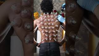 Download lagu அருவியாய் கொட்டும் குடுவை சிகிச்சை அருணின் முதுகில் இருந்து #cupping #cuppingtherapy #chennai #face mp3 Download lagu அருவியாய் கொட்டும் குடுவை சிகிச்சை அருணின் முதுகில் இருந்து #cupping #cuppingtherapy #chennai #face mp3