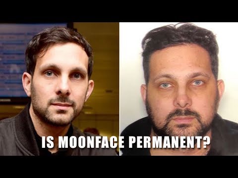 Is Moonface Permanent? Does it affect you for the rest of your life?