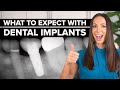 What to Expect with Dental Implants