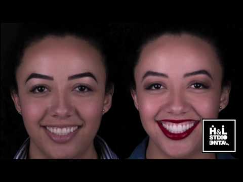 Entr a paciente que se le realizó tratamiento de carillas tipo lente de contacto