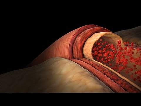 Alta Presión Sanguínea