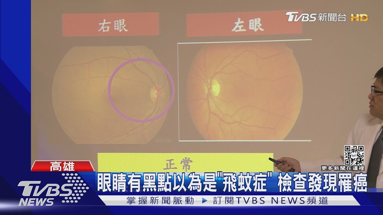 19歲少女「飛蚊症」就醫 竟是「癌細胞」擴散影響視力