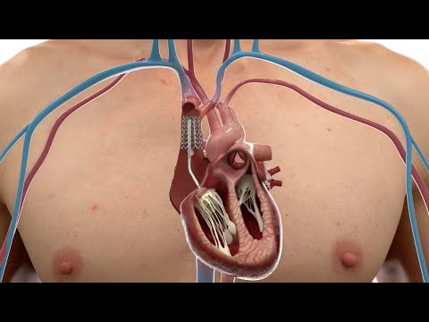 CroiValve Animation - DUO Tricuspid Coaptation Valve System