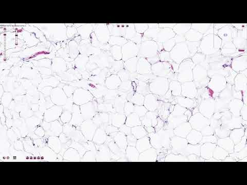 Lipoma - Histopathology