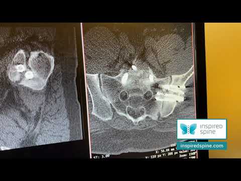 Sacroiliac Joint is adjacent segment disease to Spine and treatment is very effective