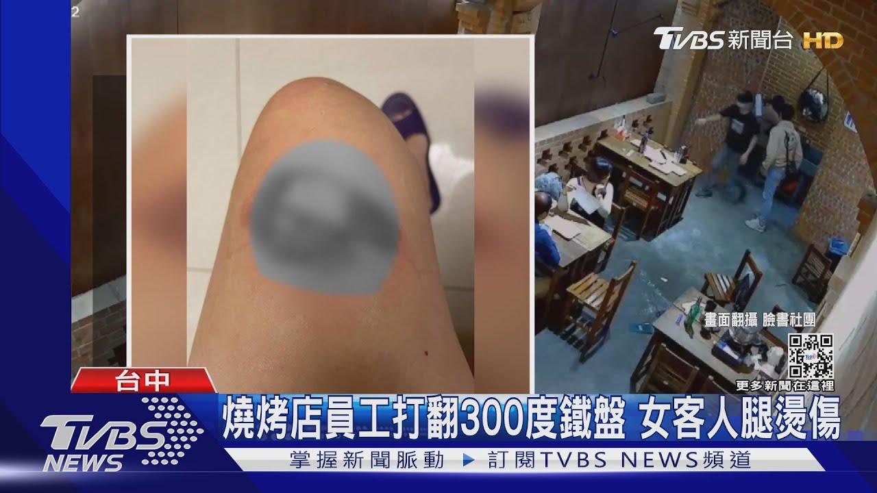 燒烤店員工打翻300度鐵盤　女客人腿燙傷