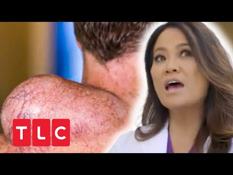 Eine Beule von der Größe zweier geballter Fäuste | Dr. Pimple Popper | TLC Deutschland