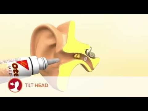 How to use Otex Ear Drops