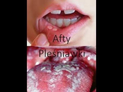 Wypadanie włosów po chemioterapii Prompt dobre witaminy dla wzrostu włosów