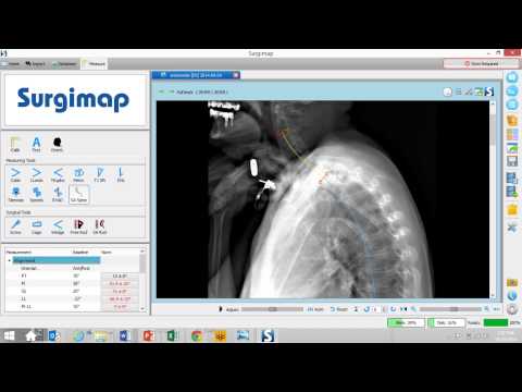 Medicrea UNiD Spinal Rod at Scoliosis and Spinal Surgery / Enthusiastic - Healthcare - - Male Voice