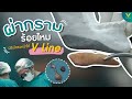 ร้อยไหม หน้าเรียว