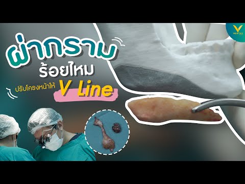ร้อยไหม หน้าเรียว