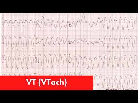 VT vs. SVT with Aberrancy | For DO, MD, NP, PA [Part 6]
