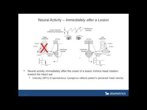 Otometrics webinar - Vestibular Compensation