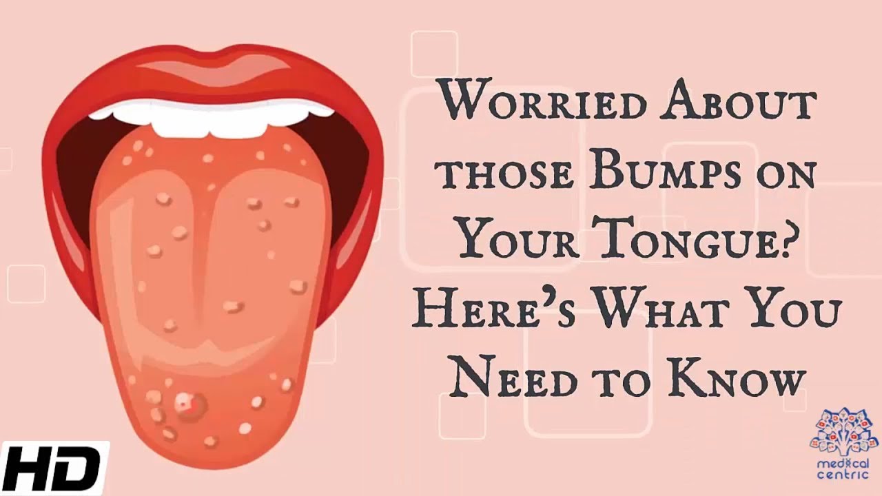 Tongue Bumps: Causes, Treatment, and Prevention, Beauty Vigour