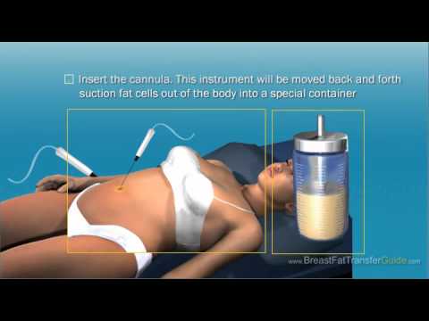 affordable body fat transfer breast augmentation Masturbationg with a condom