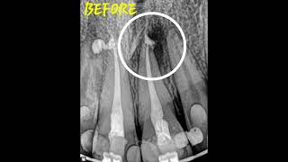 Healing of 2 periapical lesions in one patient.