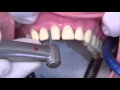 Fraisage d'une dent antérieure