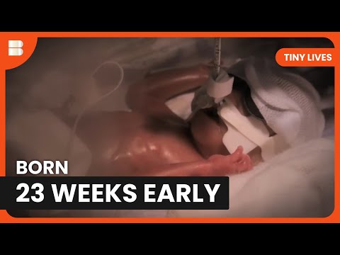 23 Week Premature Baby Charlie Fights for Life in NICU