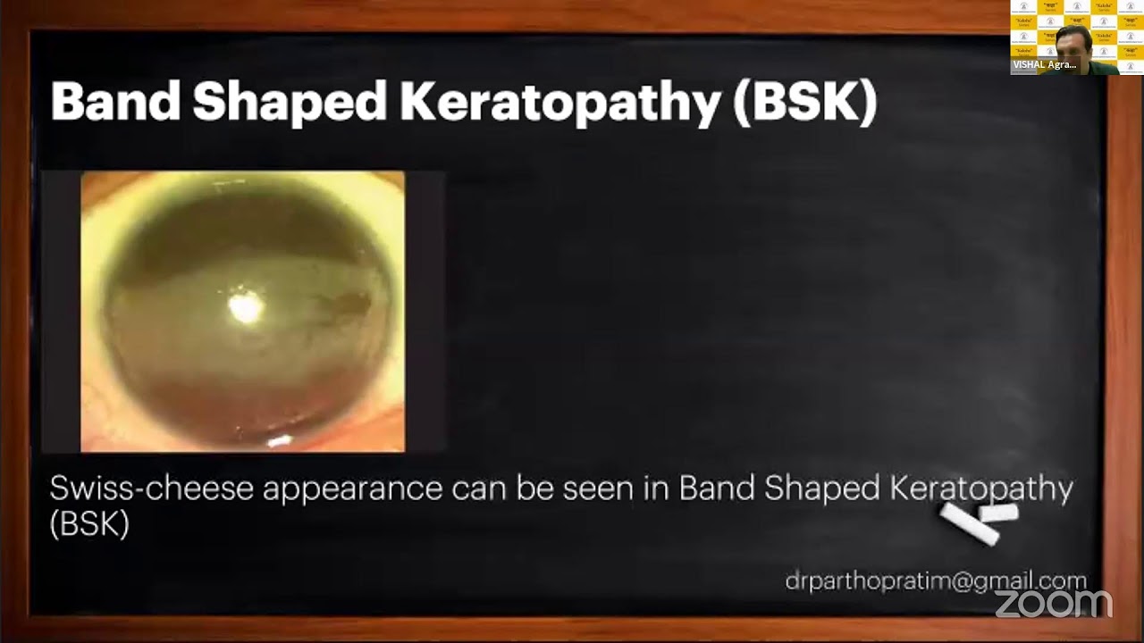 Uveitis Basics, Work up and What I Need to Know