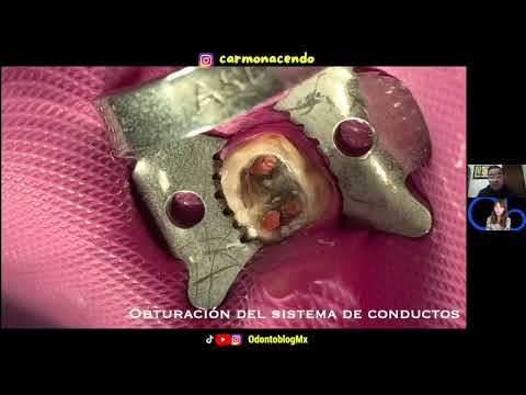 Obturación en Endodoncia