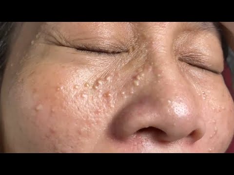 Make your Acne Treatment Huong Da Nang#502 | acne 2022...