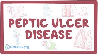 Download Lagu Peptic ulcer disease - causes, symptoms, diagnosis, treatment, pathology Thumbnail