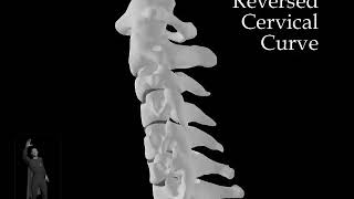 Reversed Cervical Curve