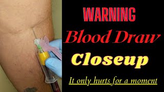 Warning!!! Closeup Blood Draw, it only hurts for a moment...