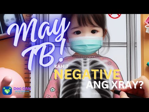 MY TB kahit NEGATIVE ang XRAY? | AskDocGan