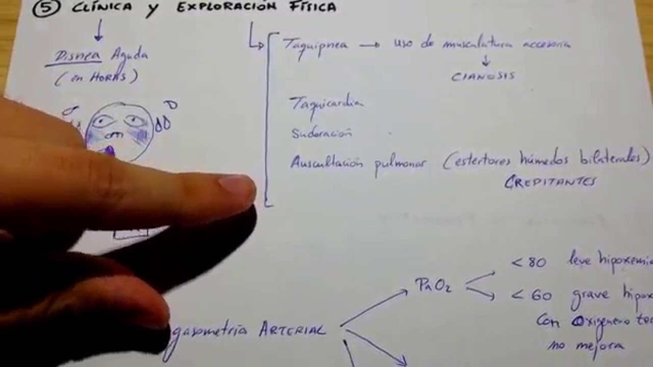 SDRA Esquema muy fácil y rápido