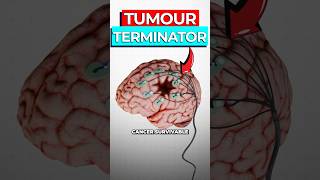 Download lagu Scientists Create Brain Implant To Cure Cancer mp3