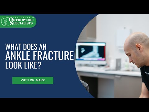 What Does An Ankle Fracture Look Like? #sportsinjuryrecovery