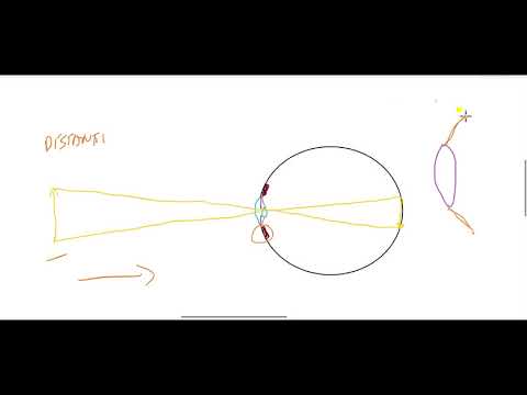 SISTEMA VISUAL 2 ERROS DE REFRAÇÃO E TRÍADE DA ACOMODAÇÃO