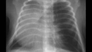 Tones On Tail- Slender Fungus