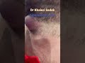 Large abscess Dr Khaled Sadek #blackheads #skincare LIPOMACYST clinic