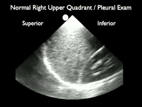 How to: Ultrasound Detection of Pleural Fluid