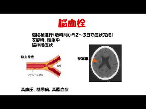 2025年度 第1回自治医科大学脳卒中・心臓病出張市民公開講座 in 県北