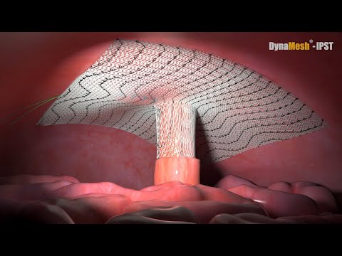 DynaMesh®-IPST Animation: Parastomal Hernia Repair with Chimney Technique