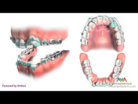 Orthodontic Treatment for Severe Crowding - Removing 4 Premolars