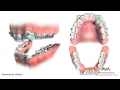 Orthodontic Treatment for Severe Crowding - Removing 4 Premolars