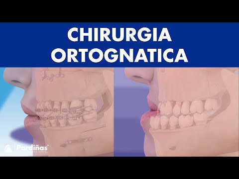 Chirurgia ORTOGNATICA - Operazione MANDIBOLA per correggere la sua posizione ©