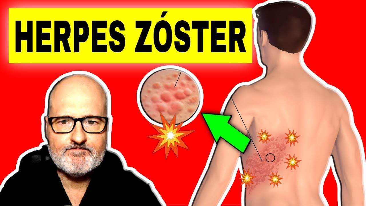 HERPES ZOSTER (Culebrilla): Síntomas, Causas y Tratamiento 🔴