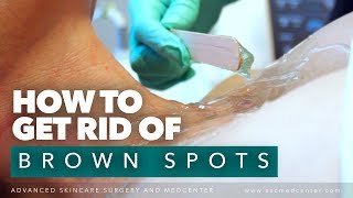 How to Remove Brown Spots from Chest and Face | IPL Treatment Los Angeles