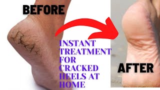 Home Remedy to get rid of CRACKED HEELS fast