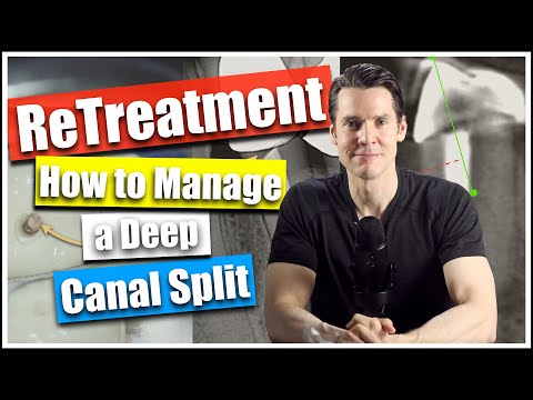 Root Canal Retreatment: How Manage a Deep Canal Split 