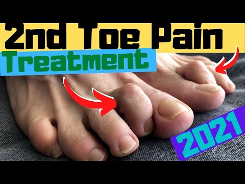 2nd Toe Capsulitis, Claw Toe & Hammer Toe RELIEF [Taping & Treatment]