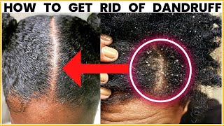 REMOVE DANDRUFF PERMANENTLY AND STOP ITCHY SCALP AT HOME - The Natural Way
