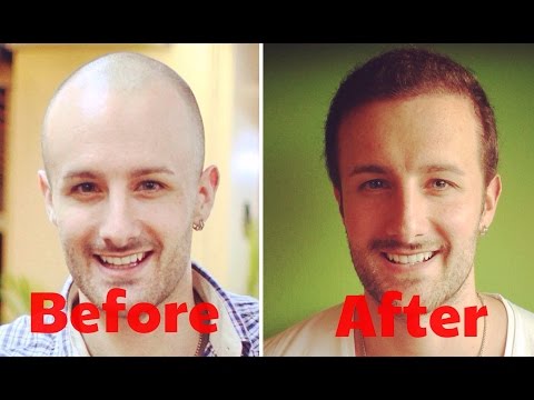 How Much Does A Hair Transplant Cost? - ANSWERED