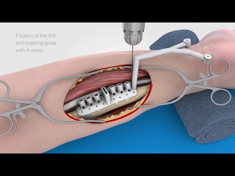 IPS Implants® Forearm Reconstruction | patient-specific implants for forearm reconstruction
